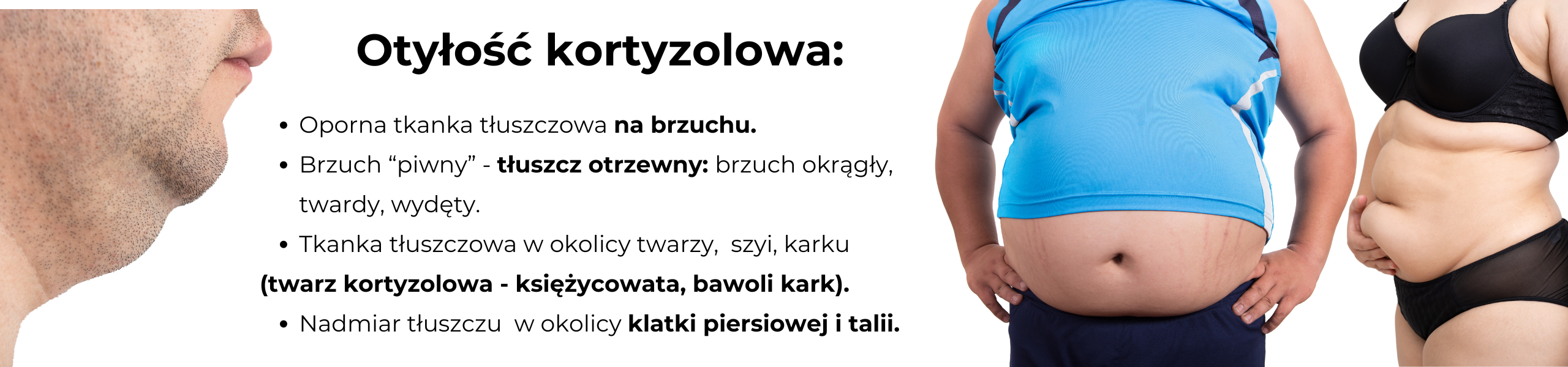 kortyzol objawy twarz kortyzolowa otylosc kortyzolowa bawoli kark